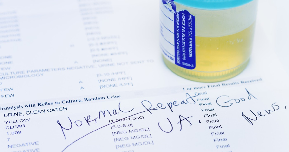 Test urină: 9 din 10 cancere de vezică depistate