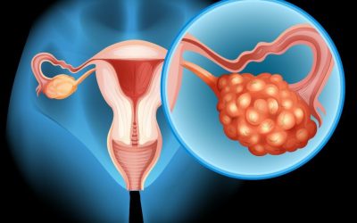 Fructoza hrănește cancerul ovarian și metastazele