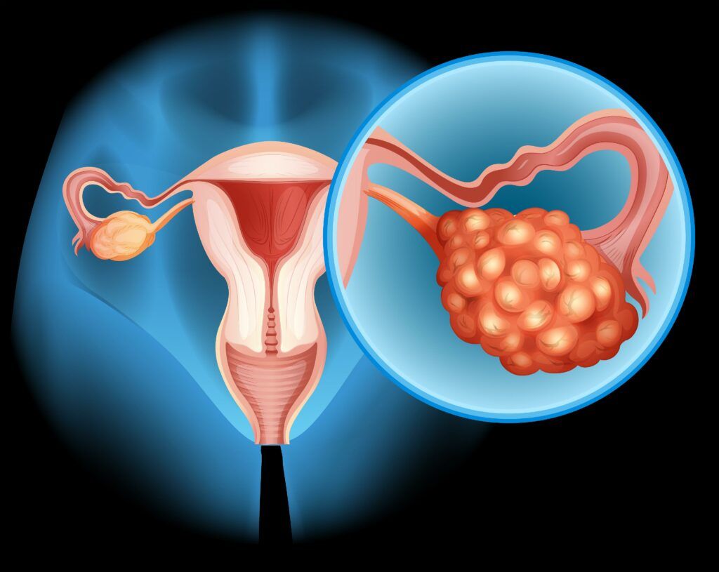 Fructoza hrănește cancerul ovarian și metastazele