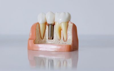 Osteointegrarea explicată: Cât durează și de ce